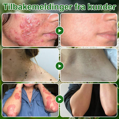 ✅Celsiora® Hudbehandlingskrem med tea tree-olje: Fjerner hudflekker, reparerer skadet hud, lysner huden og gir anti-aldring pleie ❤️‍🔥