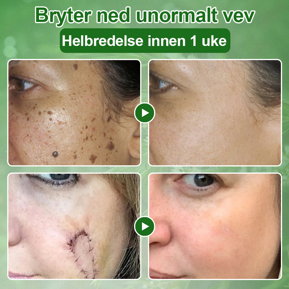 ✅Celsiora® Hudbehandlingskrem med tea tree-olje: Fjerner hudflekker, reparerer skadet hud, lysner huden og gir anti-aldring pleie ❤️‍🔥