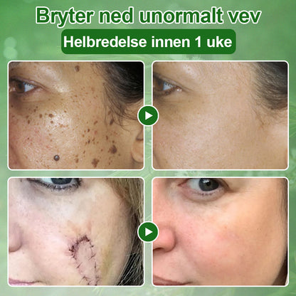 ✅Celsiora® Hudbehandlingskrem med tea tree-olje: Fjerner hudflekker, reparerer skadet hud, lysner huden og gir anti-aldring pleie ❤️‍🔥