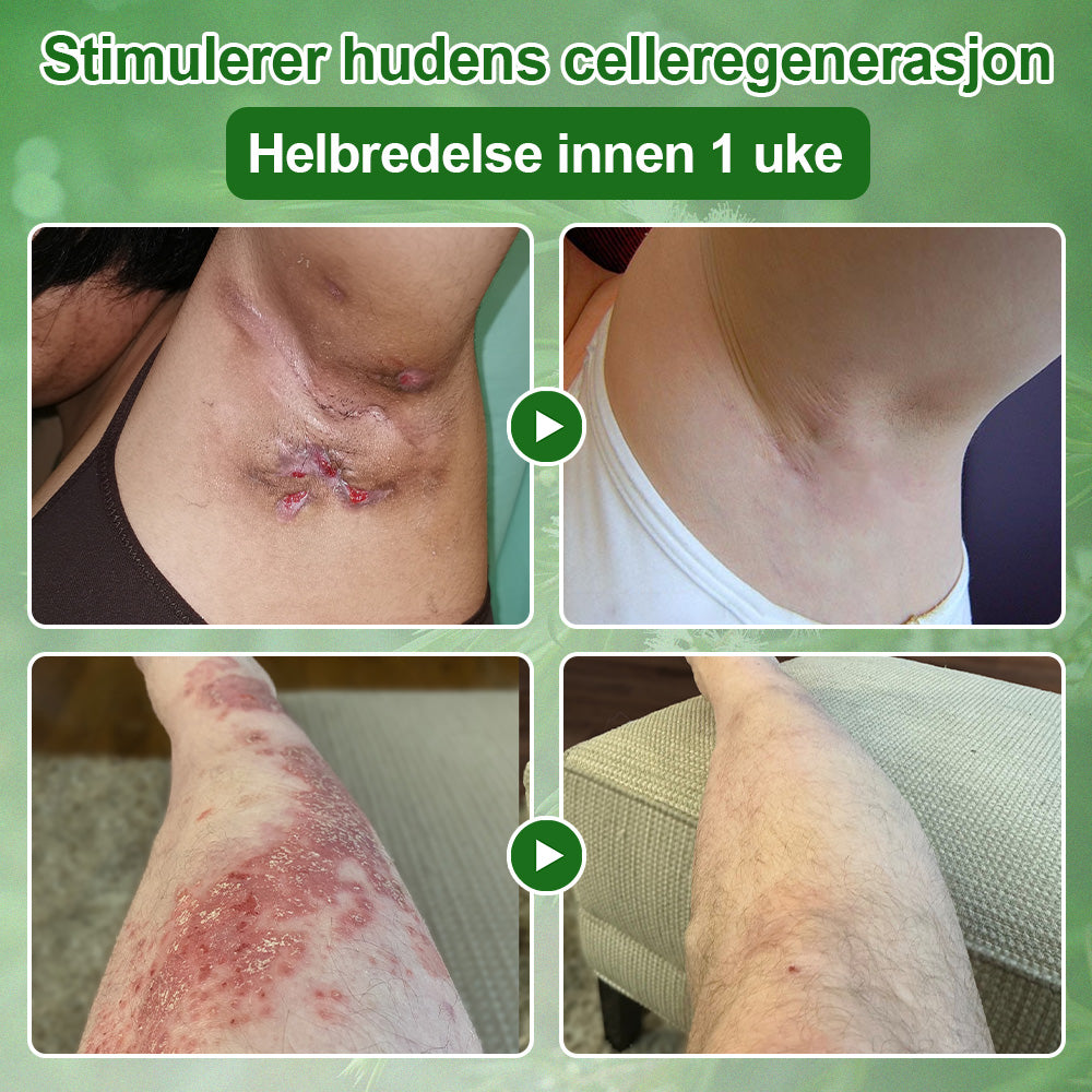 ✅Celsiora® Hudbehandlingskrem med tea tree-olje: Fjerner hudflekker, reparerer skadet hud, lysner huden og gir anti-aldring pleie ❤️‍🔥